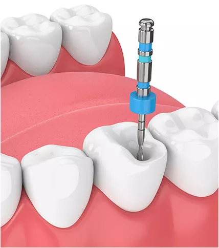 Graphic of lower teeth showing root canal prep.